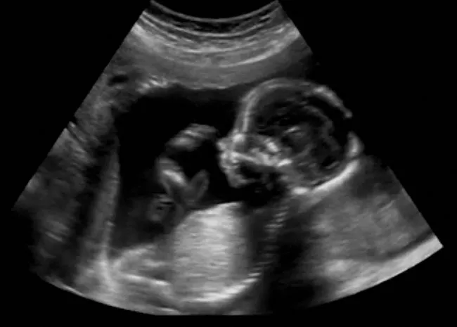 Aplicativo de Ultrassom, ScanBaby: Revolucionando a Gravidez